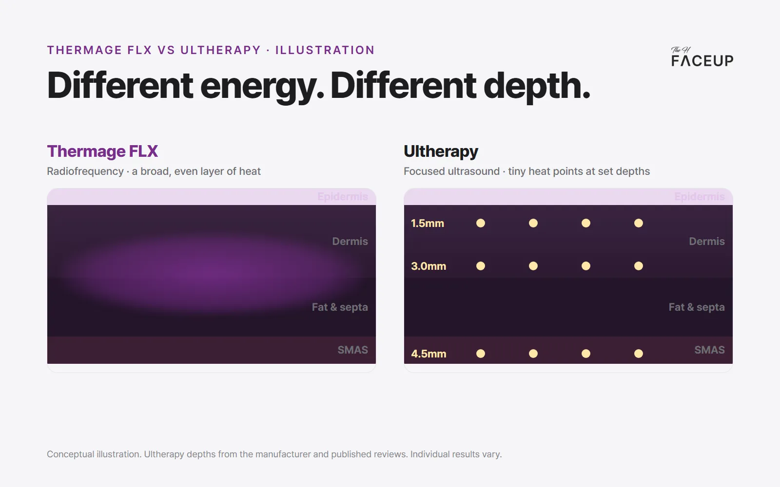 Thermage vs Ultherapy depth – broad RF heating of the dermis vs focused ultrasound points at set depths